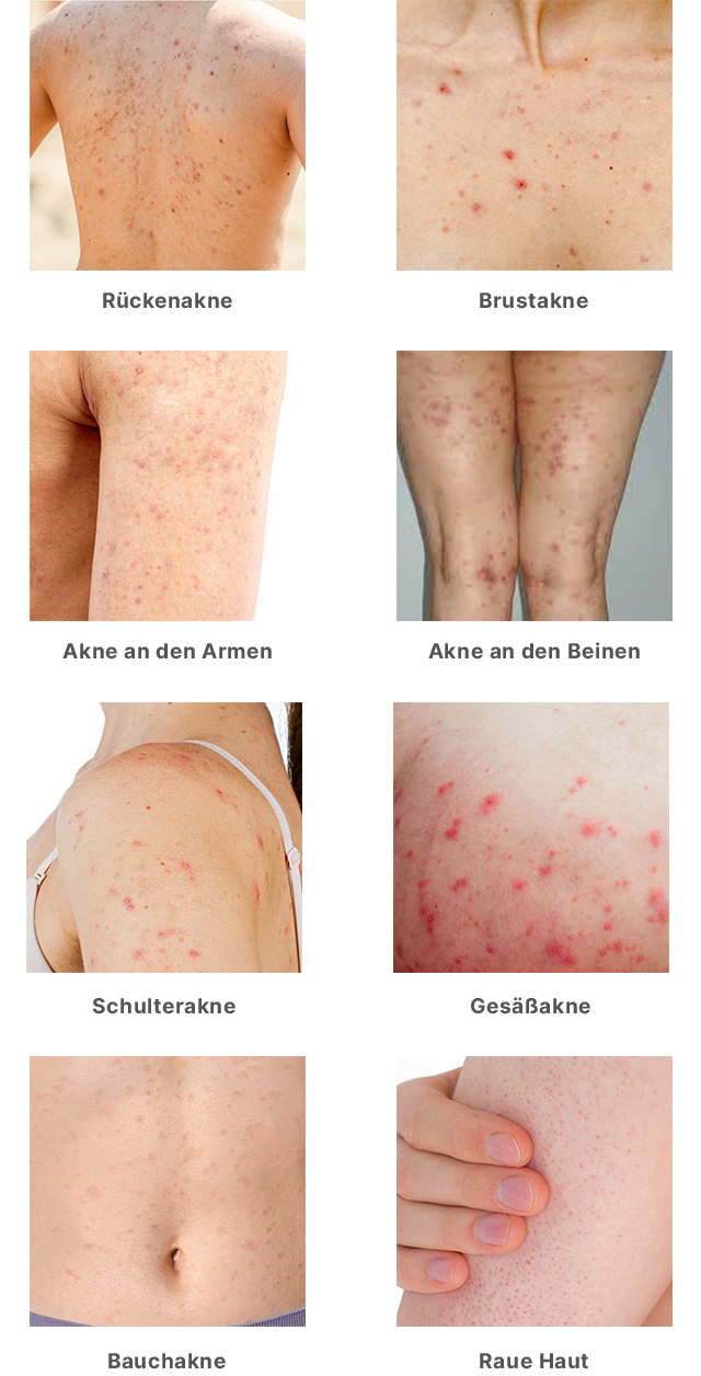 Übersicht typischer Hautprobleme am Körper wie Rückenakne, Brustakne, Akne an Armen und Beinen, Schulter- und Gesäßakne, Bauchakne und raue Haut – Anwendungsbereiche des SQT® Body Clarifying Kombi-Sets.