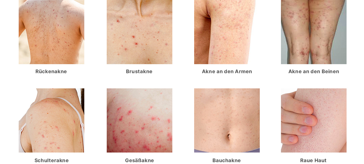Übersicht typischer Hautprobleme am Körper wie Rückenakne, Brustakne, Akne an Armen und Beinen, Schulter- und Gesäßakne, Bauchakne und raue Haut – Anwendungsbereiche des SQT® Body Clarifying Kombi-Sets.